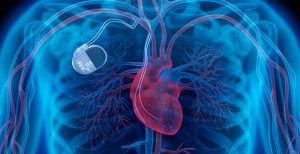 Scopri di più sull'articolo 350.000 pacemaker a rischio in USA per una falla di sicurezza. Ma c’è la patch