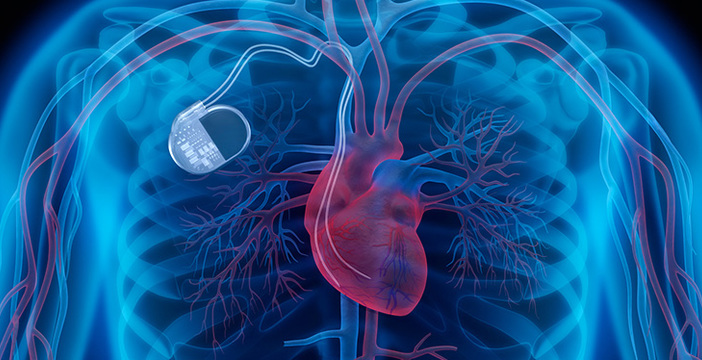 Al momento stai visualizzando 350.000 pacemaker a rischio in USA per una falla di sicurezza. Ma c’è la patch