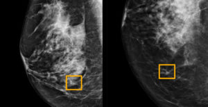 Scopri di più sull'articolo L’IA di Google è pronta a diagnosticare i tumori al seno, ma non sostituisce l’analisi del medico