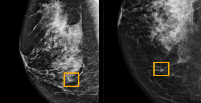 Al momento stai visualizzando L’IA di Google è pronta a diagnosticare i tumori al seno, ma non sostituisce l’analisi del medico