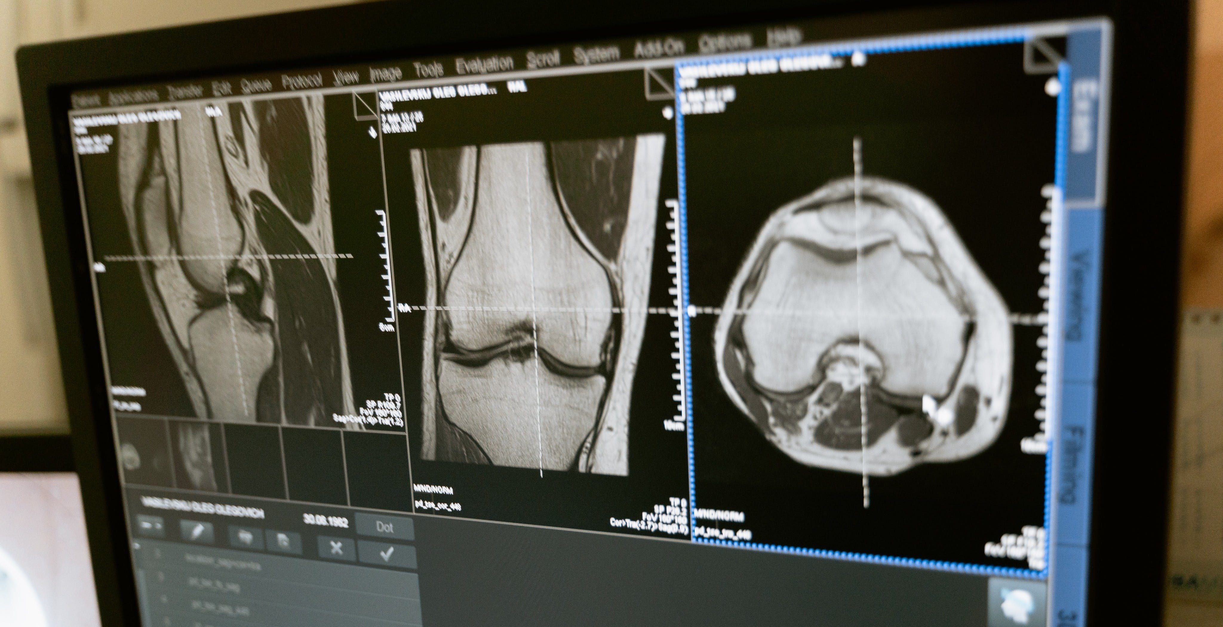 M2Test, la startup italiana che aiuta a diagnosticare in tempo l'osteoporosi. Come funziona il BES Test